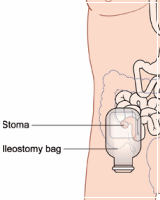 Ileostomy/Colostomy