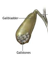 Gallbladder Disease