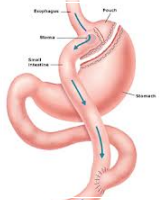 Gastric Surgery