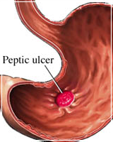 Gastritis/Peptic Ulcer Disease