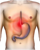 Heartburn/Gastro-esophageal reflux