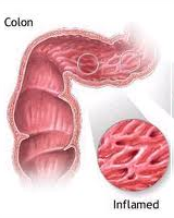 Inflammatory Bowel Disease (IBD)