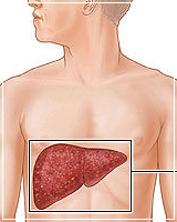 Liver Disease