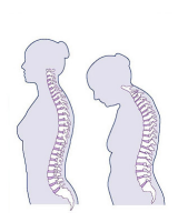 Osteopenia/Osteoporosis